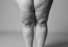 Van obesitas tot cellulite: 8 op de 10 lipoedeempatiƫnten verkeerd behandeld * Van obesitas tot cellulite: 8 op de 10 lipoedeempatiƫnten verkeerd behandeld *