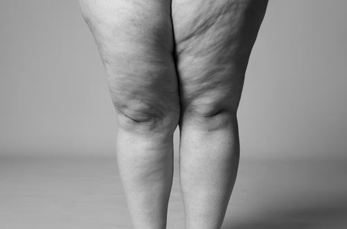 Van obesitas tot cellulite: 8 op de 10 lipoedeempatiënten verkeerd behandeld *
